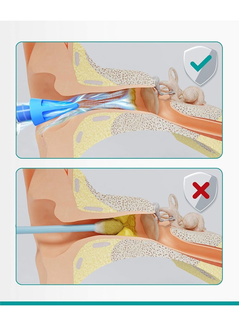 Medi Grade Ear Syringe Ear Wax Removal with 3 Quad-stream Tips - Water Irrigation Ear Cleaner Ear Wax Remover - Image 3